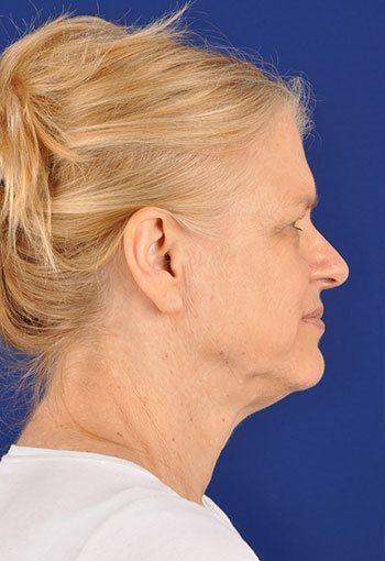 Shapiro Plastic Surgery blepharoplasty after — Scottsdale, AZ