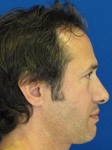 Shapiro Plastic Surgery rhinoplasty after — Scottsdale, AZ