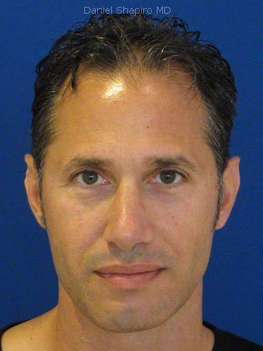 Rhinoplasty before at Shapiro Plastic Surgery in Scottsdale, AZ