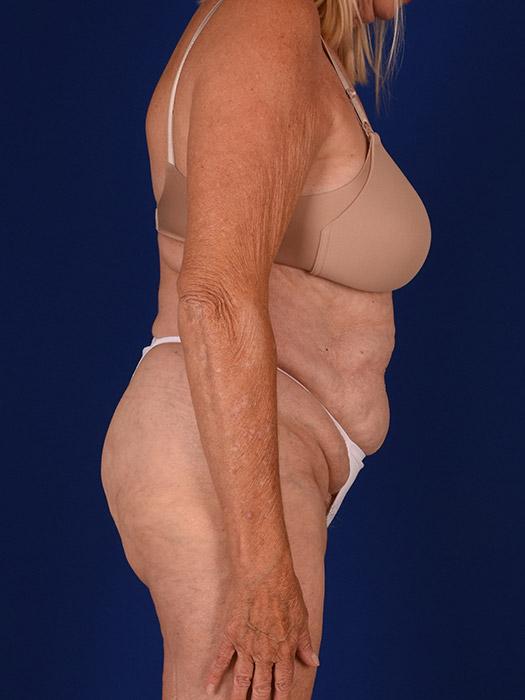 Shapiro Plastic Surgery mommy makeover after — Scottsdale, AZ