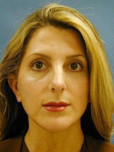 Chin Implant after at Shapiro Plastic Surgery in Scottsdale, AZ