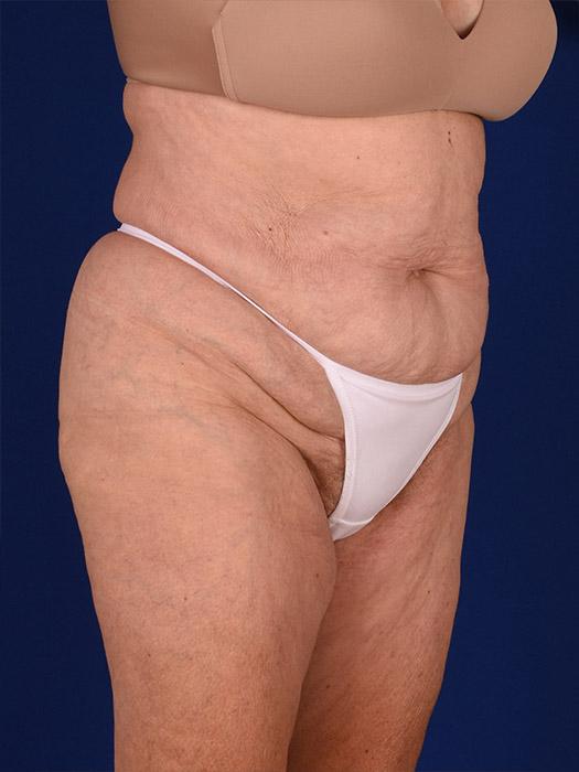 Shapiro Plastic Surgery tummy tuck after — Scottsdale, AZ