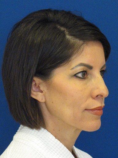 Shapiro Plastic Surgery blepharoplasty after — Scottsdale, AZ