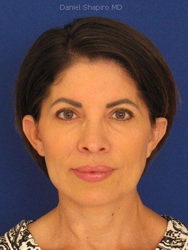 Blepharoplasty before at Shapiro Plastic Surgery in Scottsdale, AZ