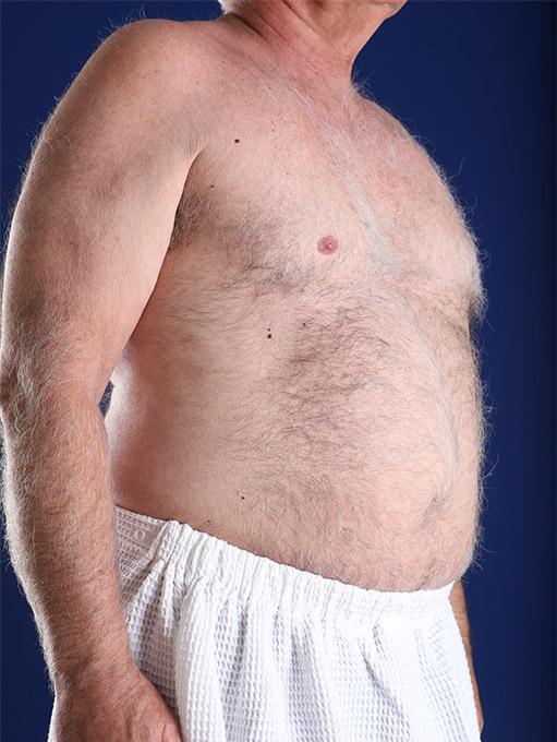Liposuction after at Shapiro Plastic Surgery in Scottsdale, AZ