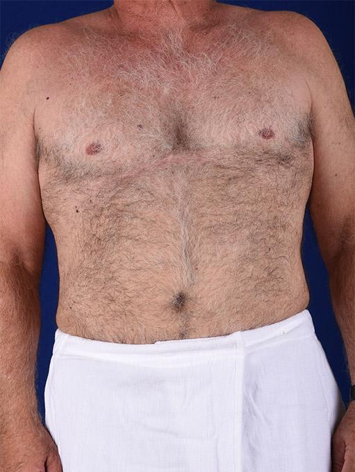 Liposuction before at Shapiro Plastic Surgery in Scottsdale, AZ