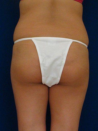 Shapiro Plastic Surgery bbl after — Scottsdale, AZ