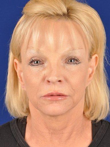 Shapiro Plastic Surgery fat transfer after — Scottsdale, AZ