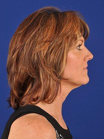 Shapiro Plastic Surgery blepharoplasty after — Scottsdale, AZ