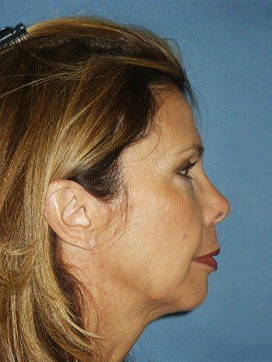 Chin Implant after at Shapiro Plastic Surgery in Scottsdale, AZ