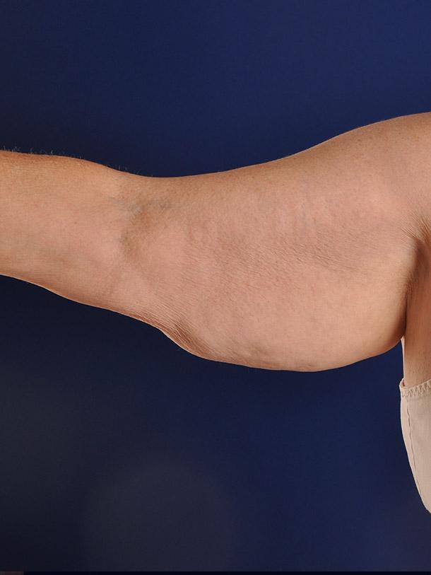 Arm Lift after at Shapiro Plastic Surgery in Scottsdale, AZ
