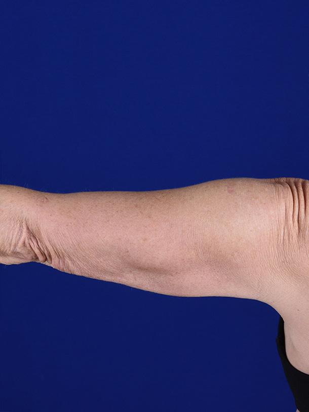 Arm Lift before at Shapiro Plastic Surgery in Scottsdale, AZ
