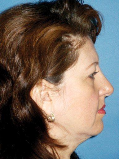 Brow Lift after at Shapiro Plastic Surgery in Scottsdale, AZ