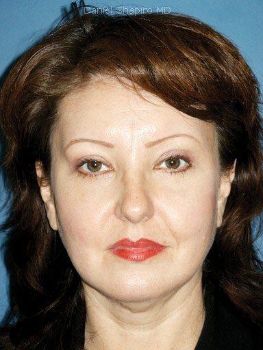Brow Lift before at Shapiro Plastic Surgery in Scottsdale, AZ