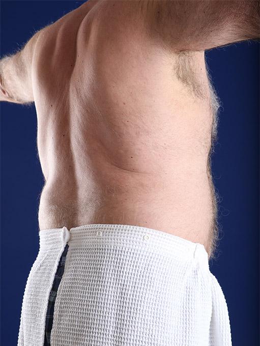 Liposuction after at Shapiro Plastic Surgery in Scottsdale, AZ