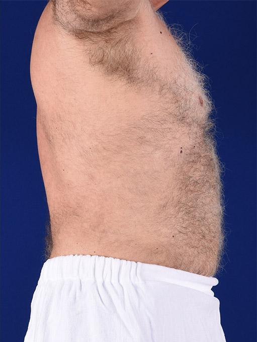 Liposuction before at Shapiro Plastic Surgery in Scottsdale, AZ