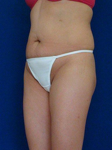 Shapiro Plastic Surgery bbl after — Scottsdale, AZ