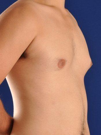 Gynecomastia Surgery after at Shapiro Plastic Surgery in Scottsdale, AZ