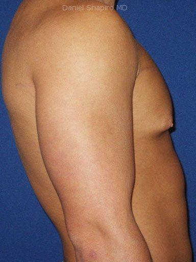 Gynecomastia Surgery before at Shapiro Plastic Surgery in Scottsdale, AZ