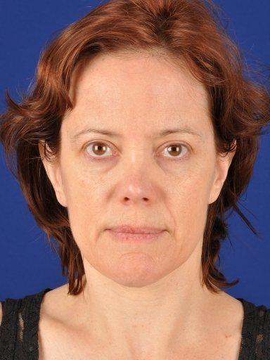 Shapiro Plastic Surgery fat transfer after — Scottsdale, AZ