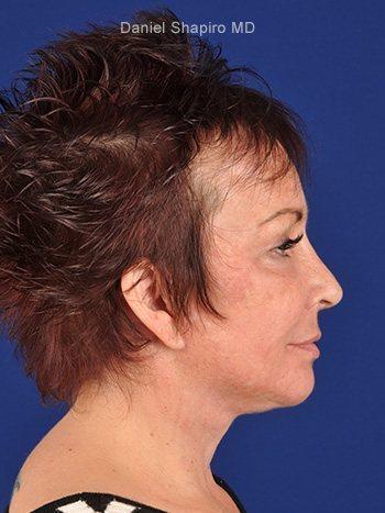 Fat Transfer before at Shapiro Plastic Surgery in Scottsdale, AZ