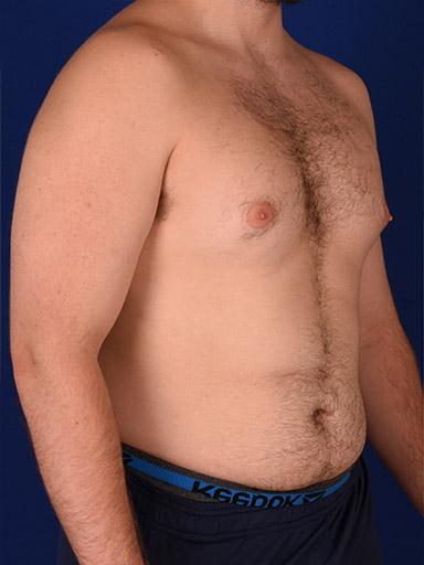 Shapiro Plastic Surgery gynecomastia after — Scottsdale, AZ