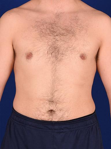 Gynecomastia Surgery before at Shapiro Plastic Surgery in Scottsdale, AZ