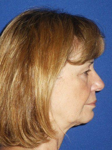 Shapiro Plastic Surgery blepharoplasty after — Scottsdale, AZ