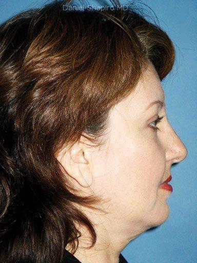 Brow Lift before at Shapiro Plastic Surgery in Scottsdale, AZ