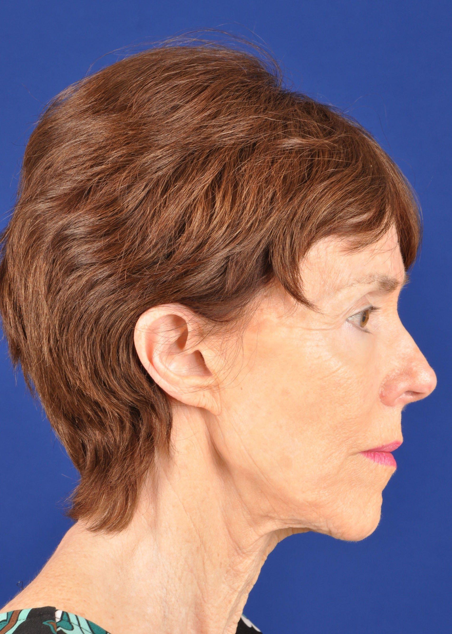 Shapiro Plastic Surgery facelift after — Scottsdale, AZ