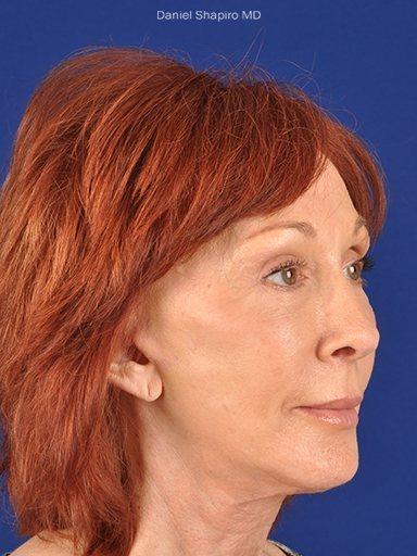 Neck Lift before at Shapiro Plastic Surgery in Scottsdale, AZ