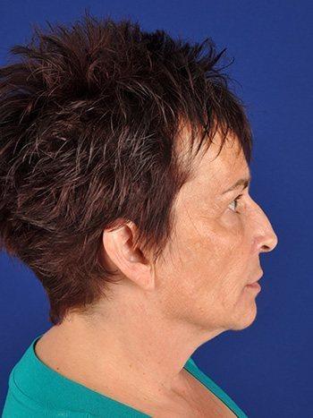 Shapiro Plastic Surgery fat transfer after — Scottsdale, AZ