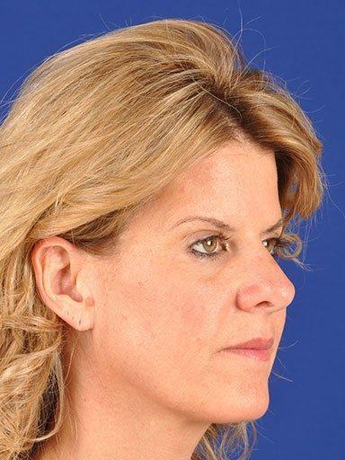 Shapiro Plastic Surgery facelift after — Scottsdale, AZ