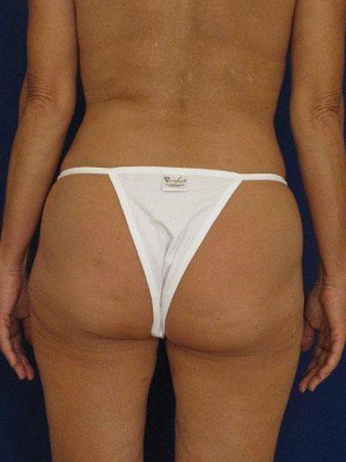 Shapiro Plastic Surgery bbl after — Scottsdale, AZ