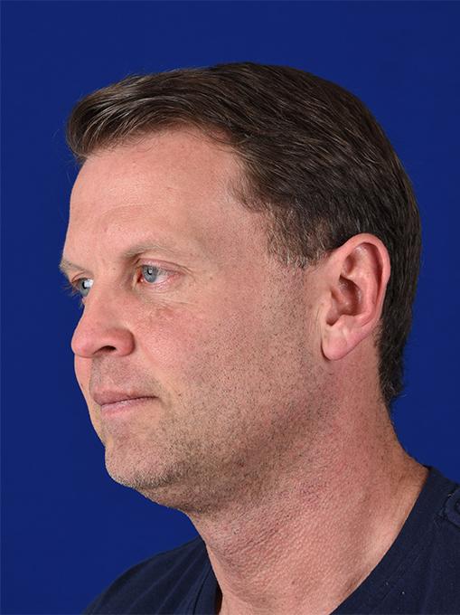 Shapiro Plastic Surgery rhinoplasty after — Scottsdale, AZ
