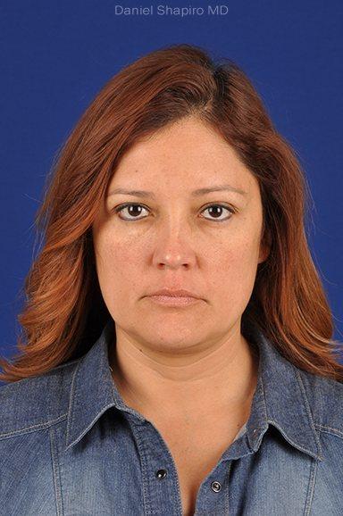 Shapiro Plastic Surgery blepharoplasty after — Scottsdale, AZ