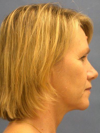 Brow Lift after at Shapiro Plastic Surgery in Scottsdale, AZ