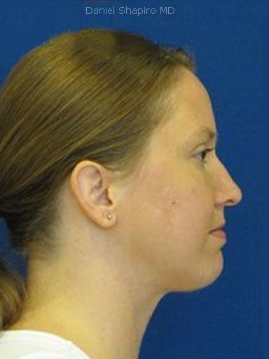 Chin Implant before at Shapiro Plastic Surgery in Scottsdale, AZ
