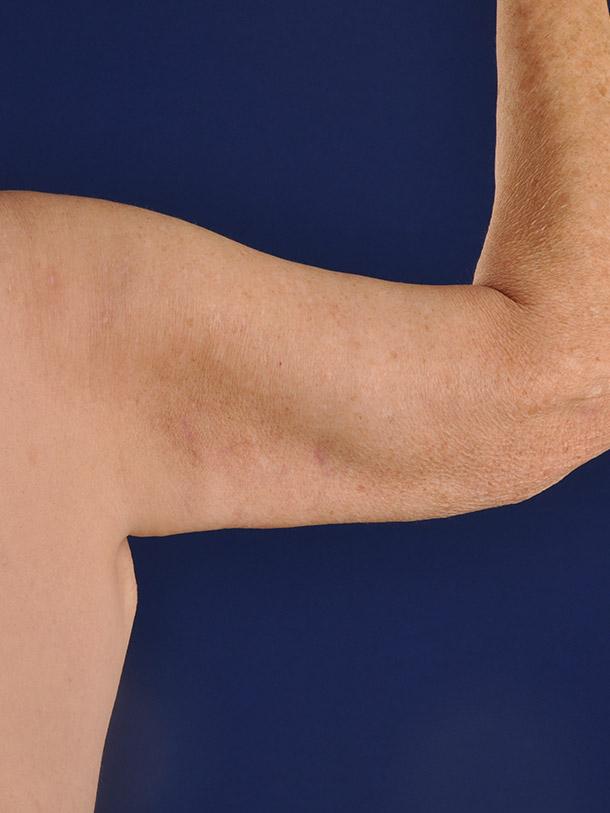 Arm Lift before at Shapiro Plastic Surgery in Scottsdale, AZ