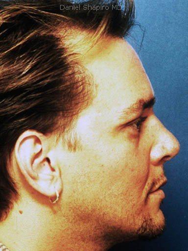 Rhinoplasty before at Shapiro Plastic Surgery in Scottsdale, AZ
