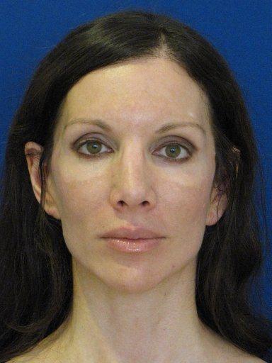 Shapiro Plastic Surgery fat transfer after — Scottsdale, AZ