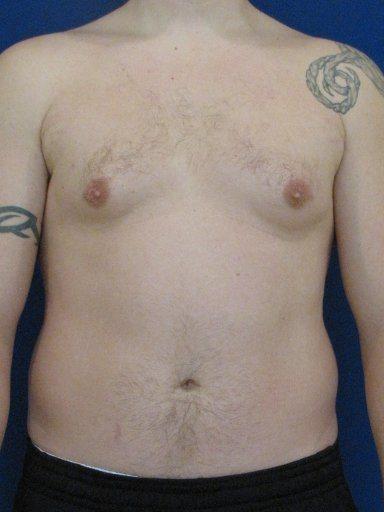Gynecomastia Surgery after at Shapiro Plastic Surgery in Scottsdale, AZ