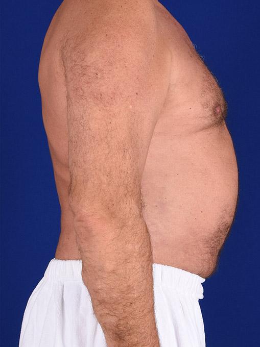 Gynecomastia Surgery before at Shapiro Plastic Surgery in Scottsdale, AZ