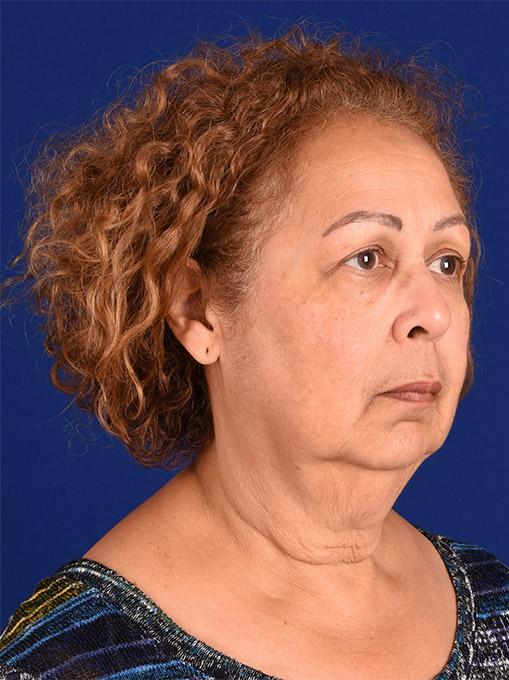 Chin Implant after at Shapiro Plastic Surgery in Scottsdale, AZ