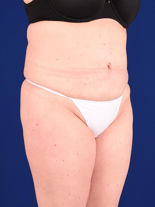 Shapiro Plastic Surgery tummy tuck after — Scottsdale, AZ