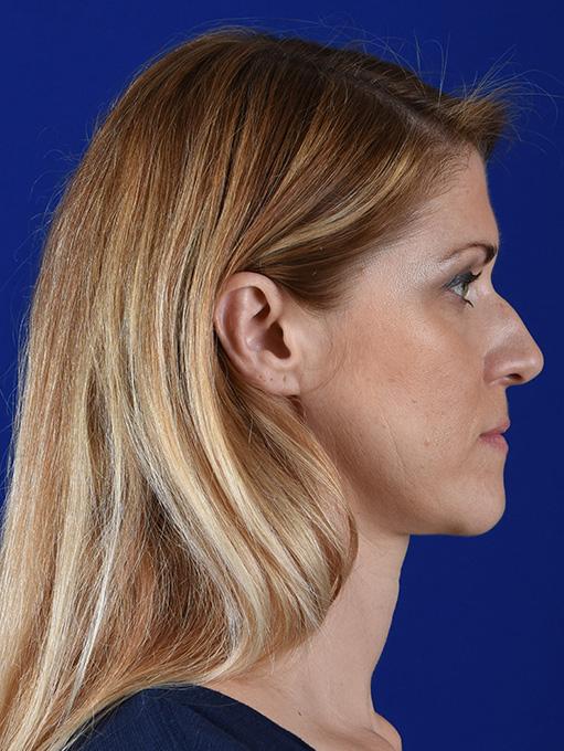 Fat Transfer after at Shapiro Plastic Surgery in Scottsdale, AZ