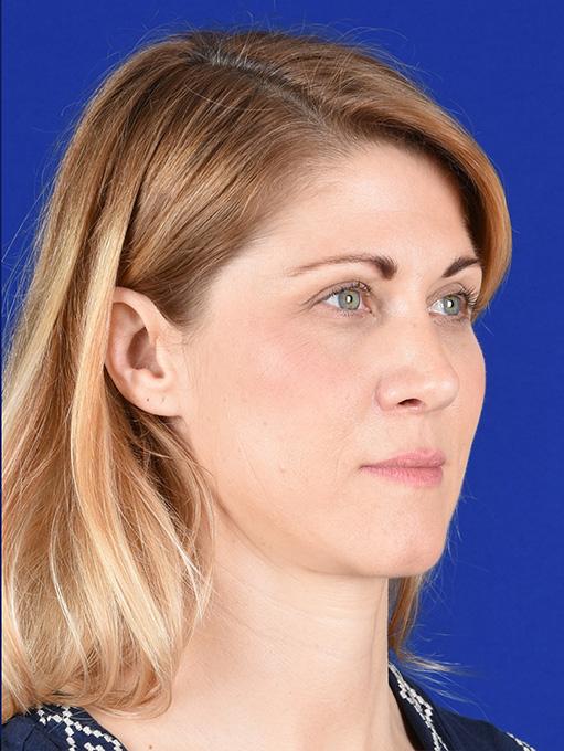 Fat Transfer before at Shapiro Plastic Surgery in Scottsdale, AZ