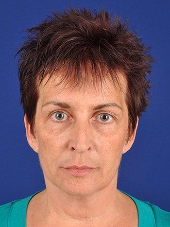 Shapiro Plastic Surgery fat transfer after — Scottsdale, AZ