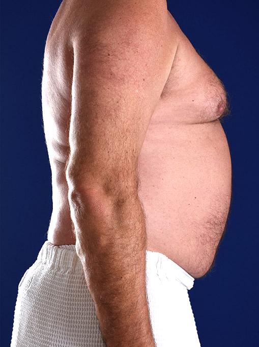 Gynecomastia Surgery after at Shapiro Plastic Surgery in Scottsdale, AZ