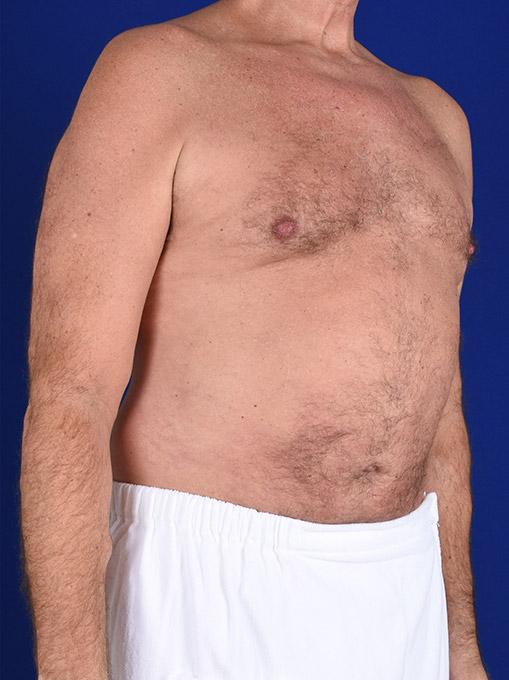 Gynecomastia Surgery before at Shapiro Plastic Surgery in Scottsdale, AZ
